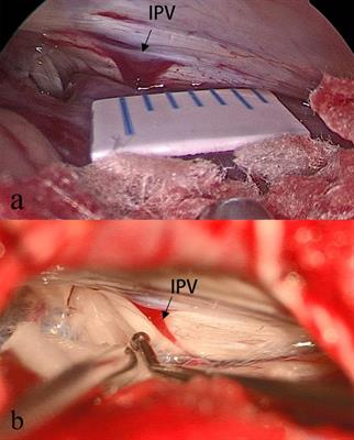 Intraoperative Findings of Inferior Petrosal Vein During Microvascular Decompression for Hemifacial Spasm: A Single-Surgeon Experience